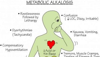 hypochloremic metabolic alkalosis