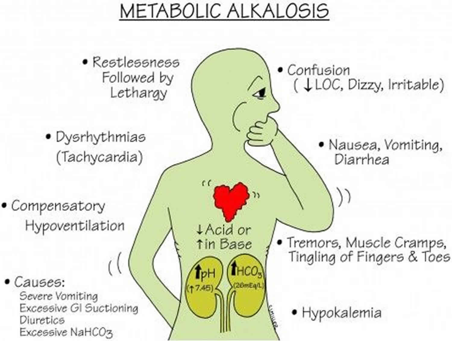 Metabolic Alkalosis Definition Causes Symptoms Diagnosis Treatment Prognosis