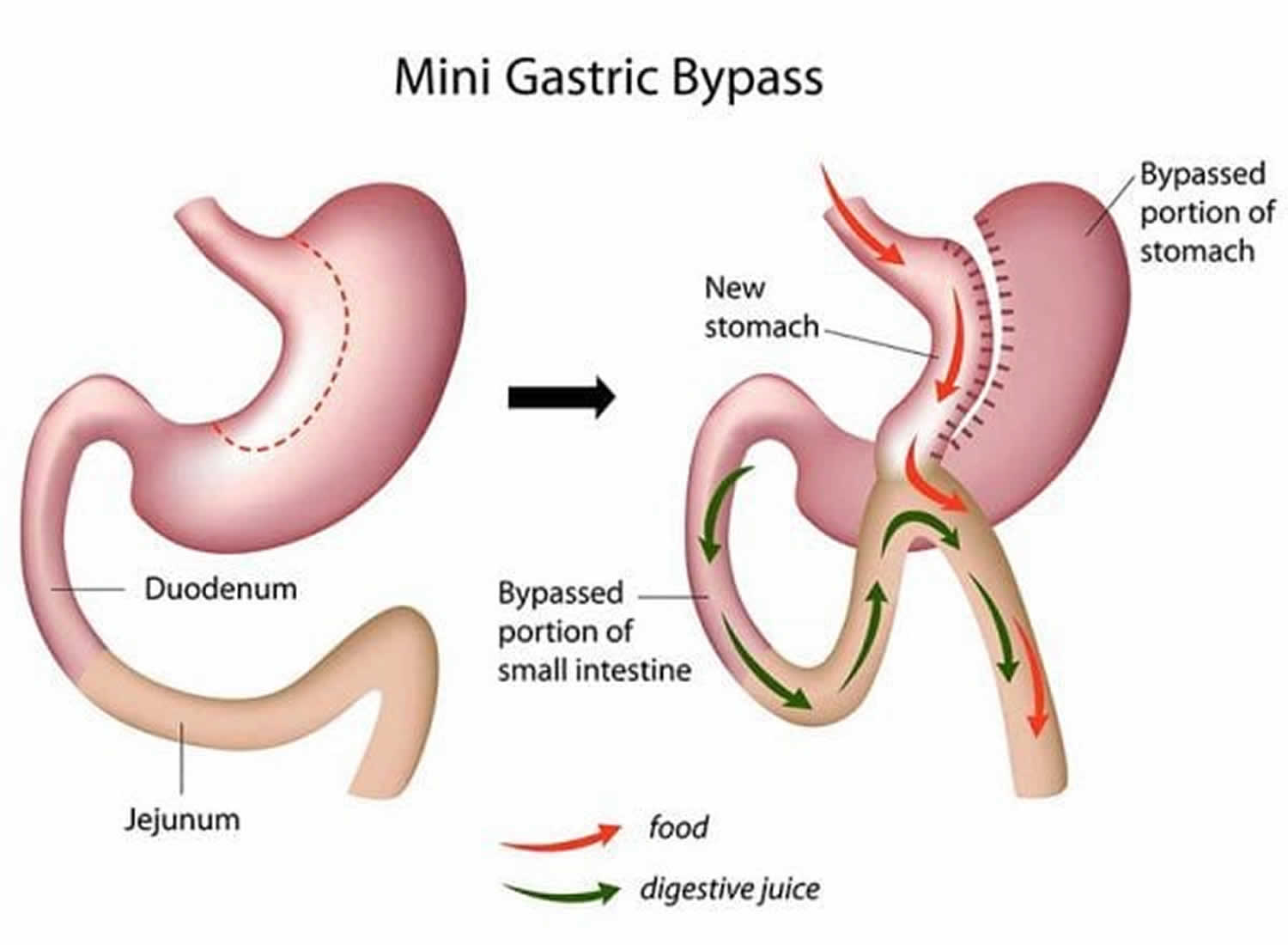 mini-gastric bypass