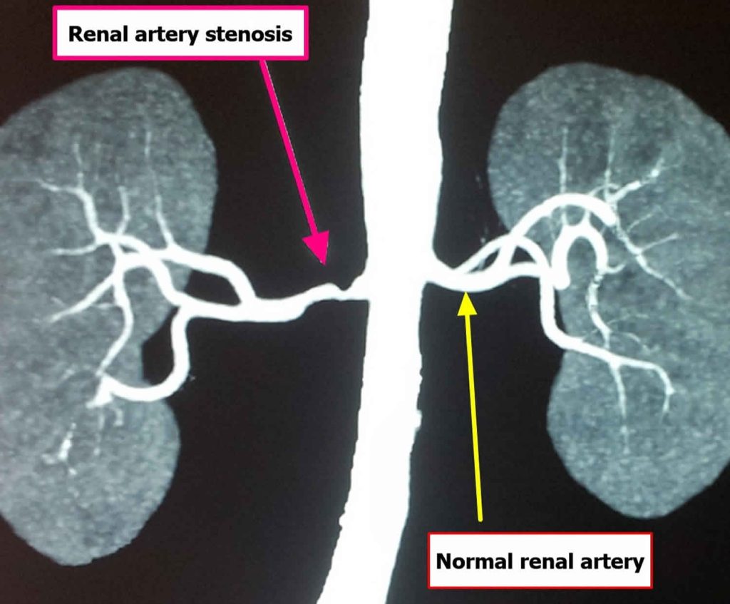 Renal Artery Stenosis Causes Symptoms Diagnosis Treatment