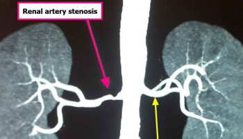 renal artery stenosis