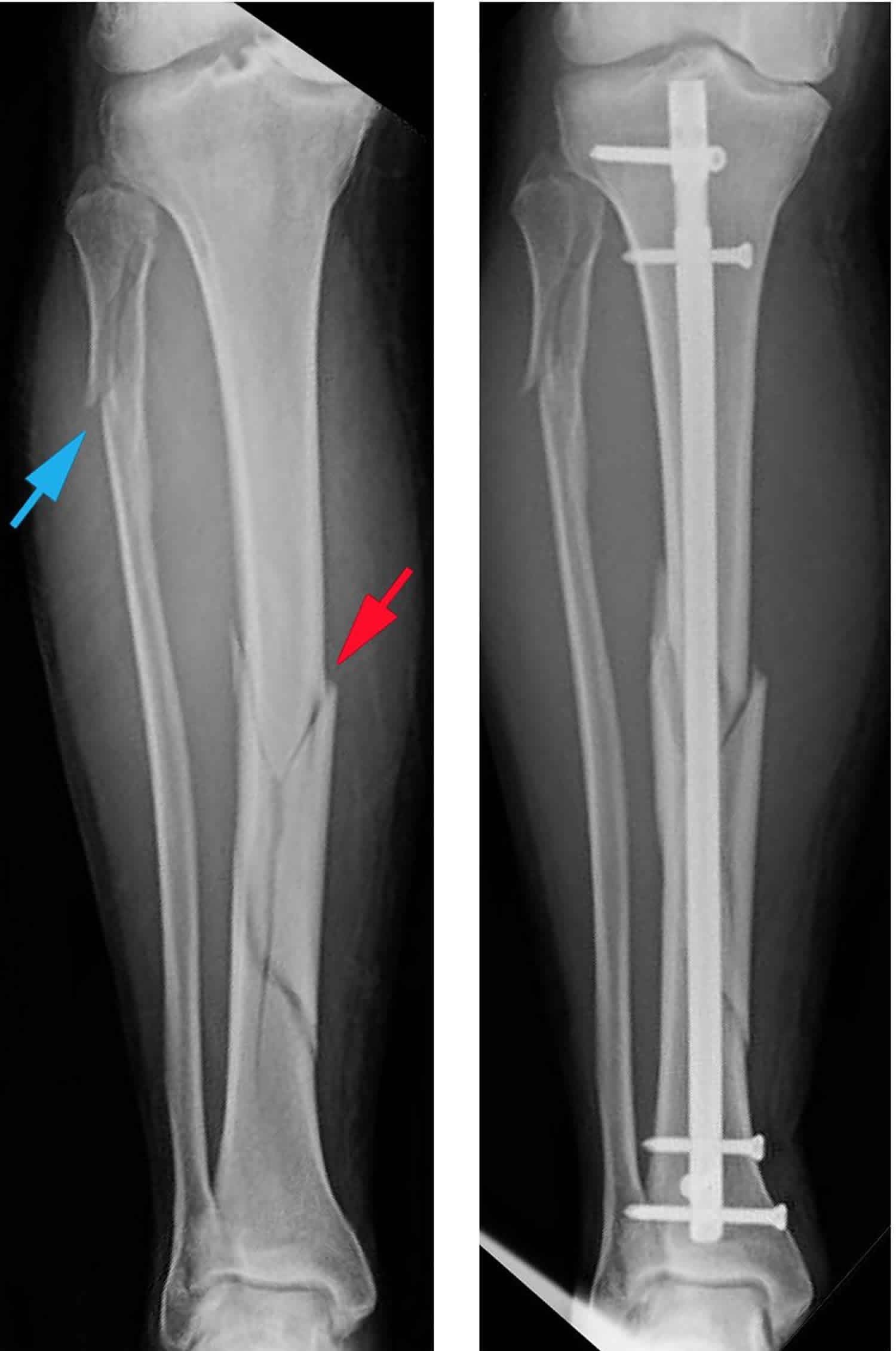 How Long To Heal Spiral Fracture Fibula