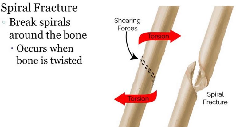 Spiral Fracture Definition Causes Symptoms Treatment And Recovery Time