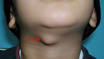 thyroglossal-duct-cyst