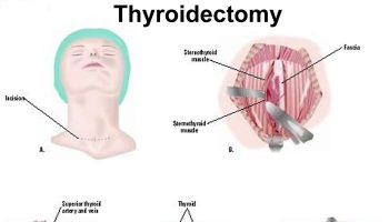 thyroidectomy