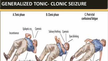 tonic-clonic-seizure