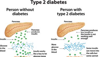 type 2 diabetes