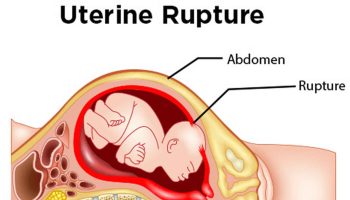 uterine-rupture