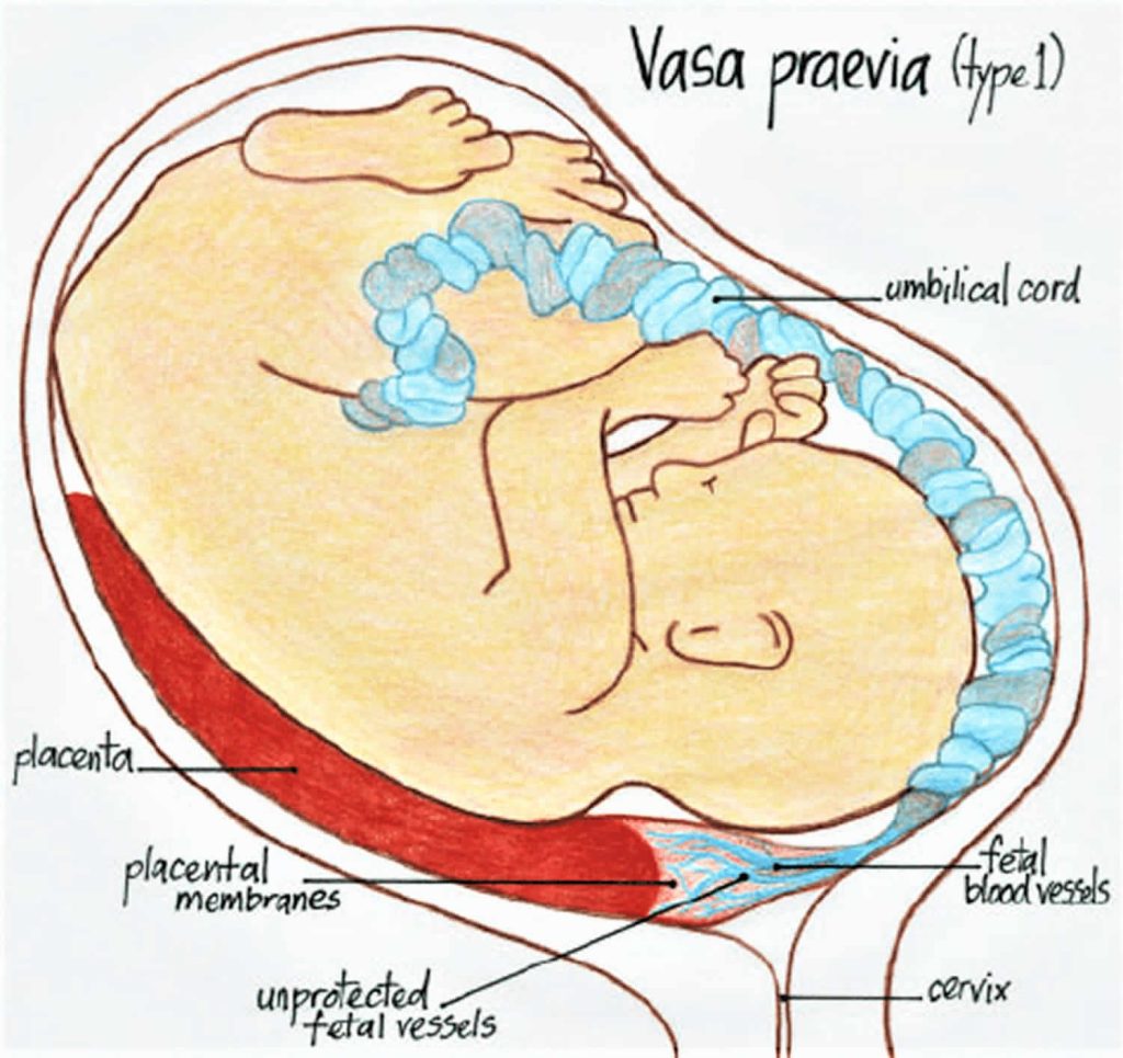 Vasa Previa Definition, Causes, Symptoms, Diagnosis, Ultrasound ...