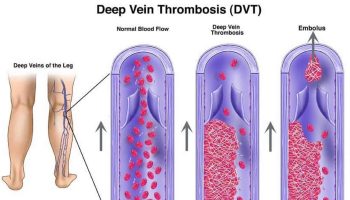 venous-thromboembolism