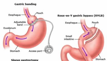 weight loss surgery