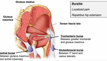 Ischial-bursitis