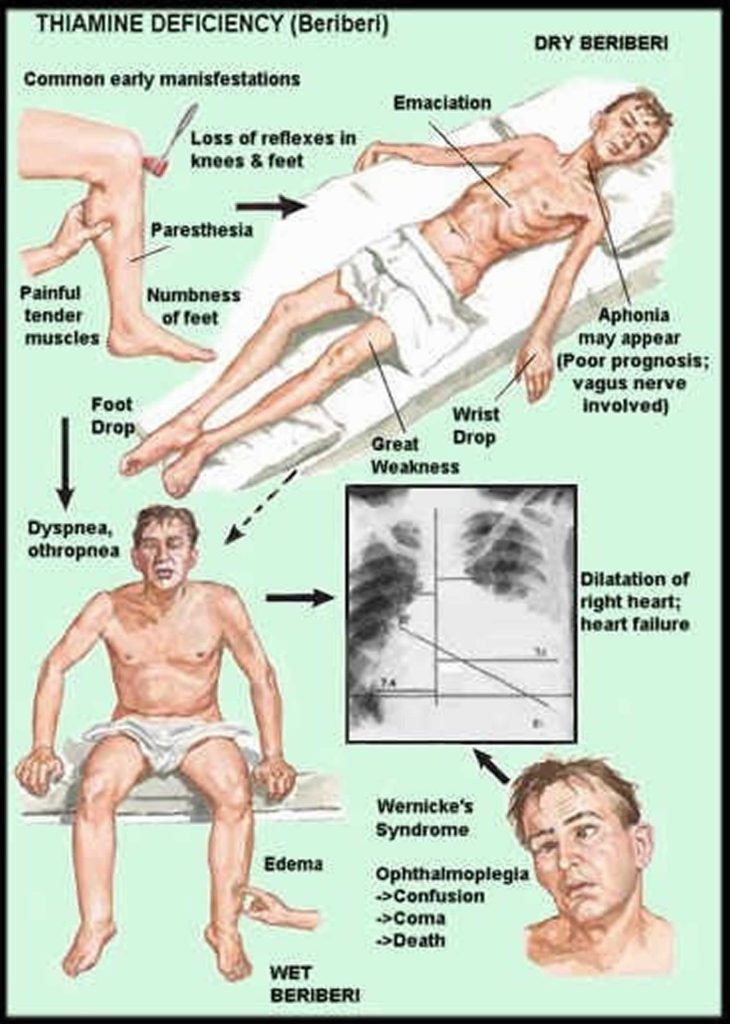 thiamine-deficiency-beriberi-causes-symptoms-diagnosis-treatment