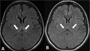 Wernicke’s encephalopathy