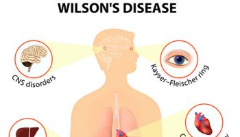 Wilson-disease