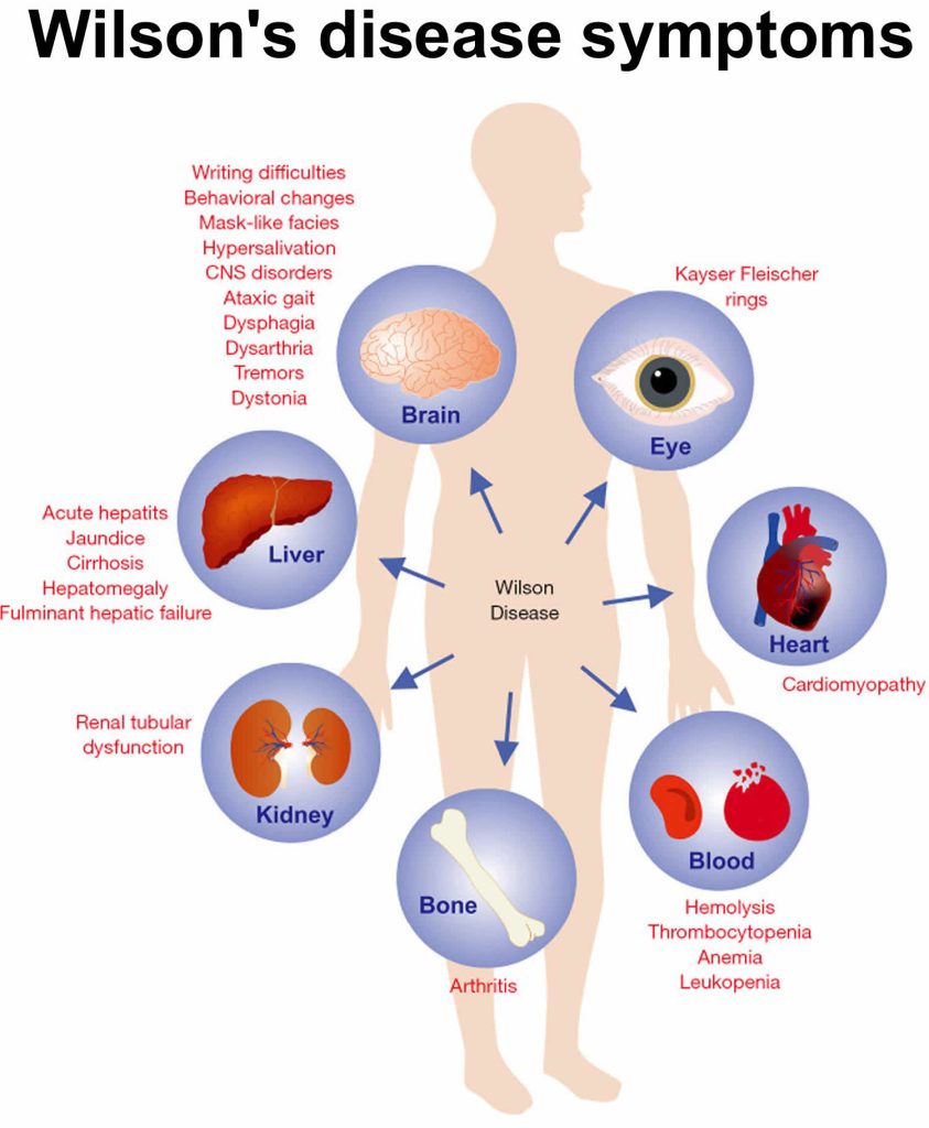 Wilson disease causes, symptoms, diagnosis, complications & treatment