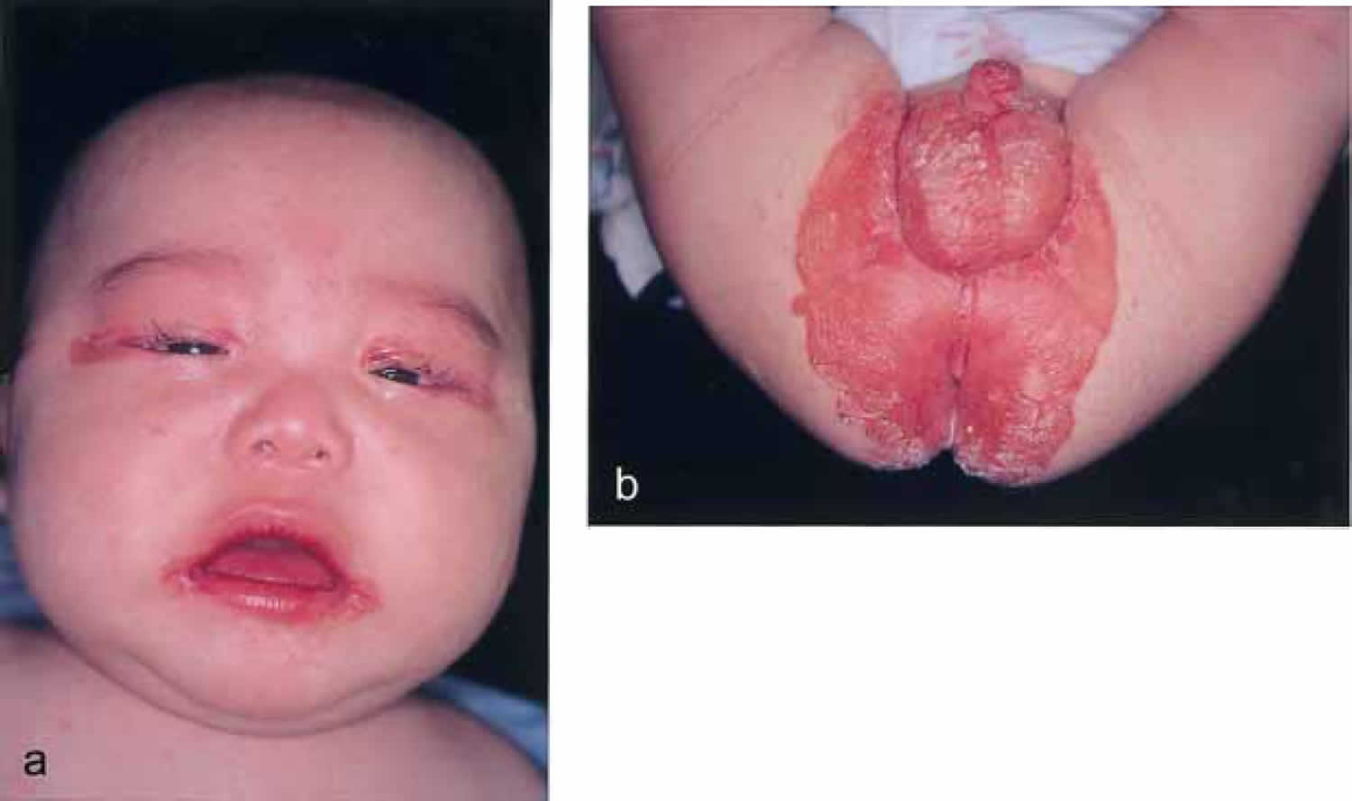 Biotin deficiency in an infant fed with amino acid formula
