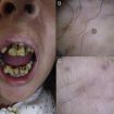 Vitamin C deficiency