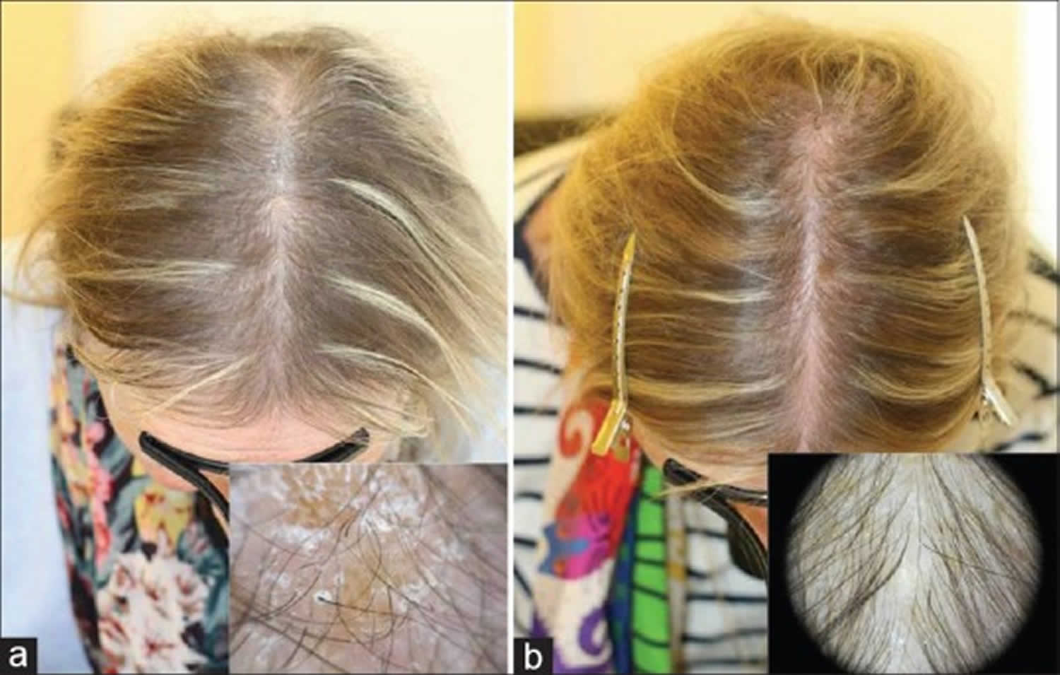 Biotin deficiency hair loss