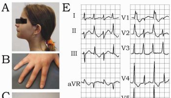 Andersen Tawil syndrome