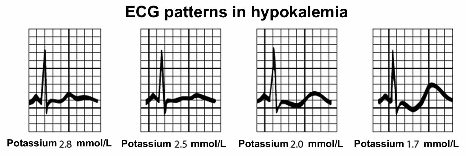ECG patterns in hypokalemia