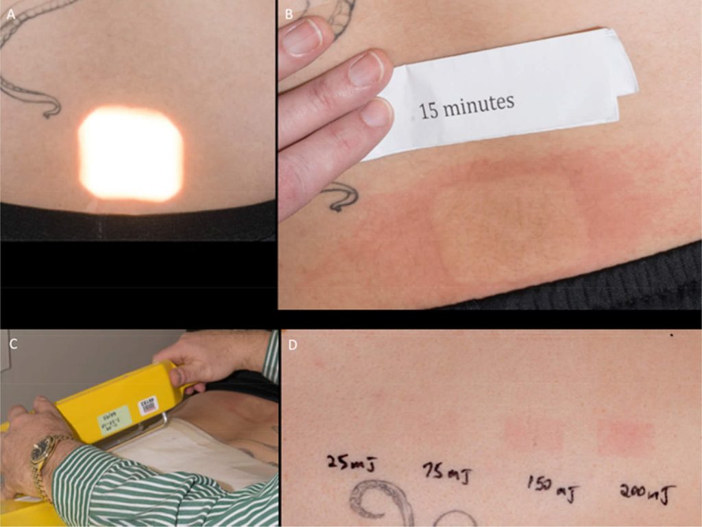 Solar urticaria causes, signs, symptoms, diagnosis & treatment