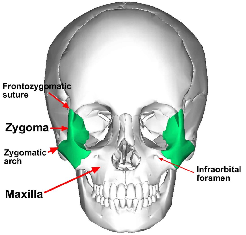 Zygoma anatomy, zygoma fracture & zygoma surgery