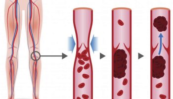 antithrombin