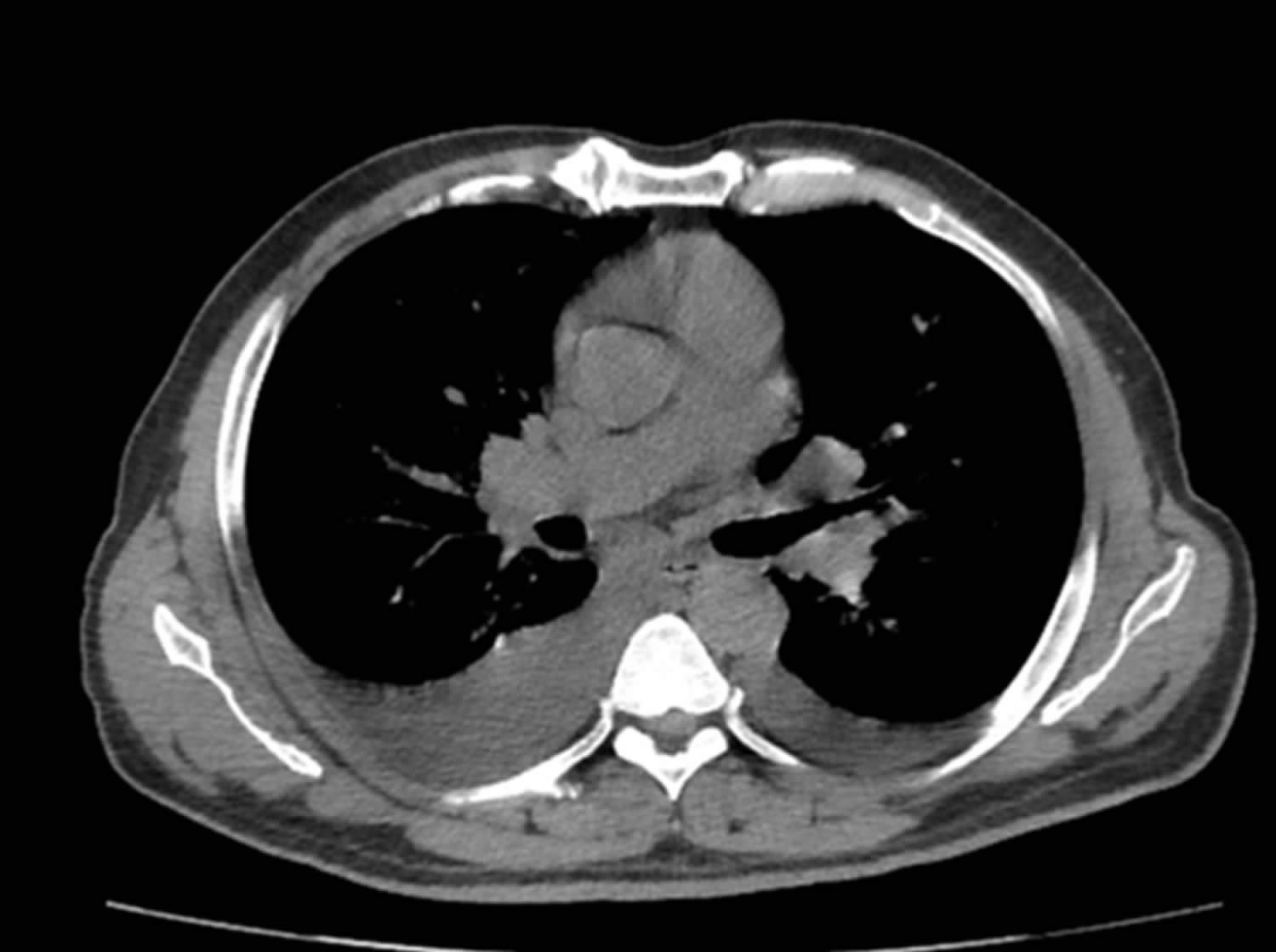 Pulmonary edema CT