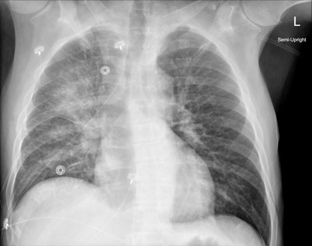 Pulmonary edema, causes, symptoms, diagnosis, treatment & prognosis