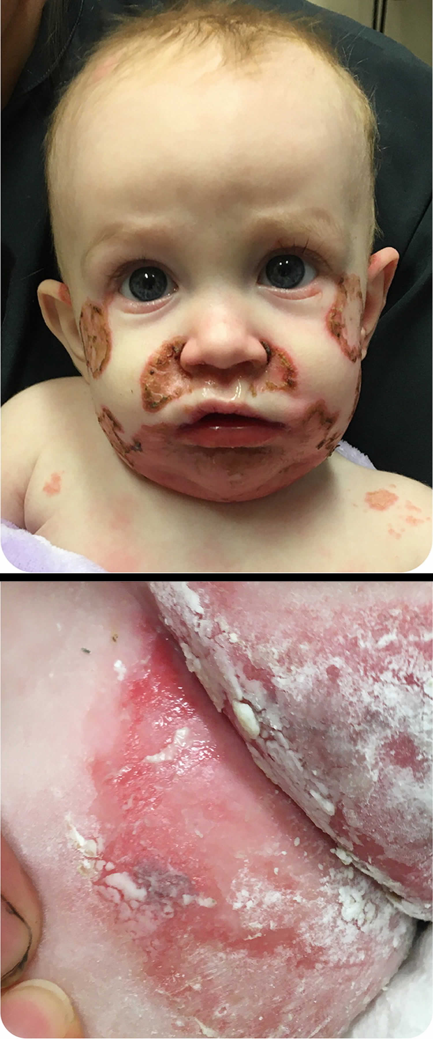 Zinc deficiency in a 5 month old baby