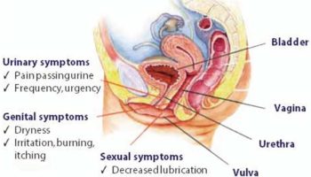 genitourinary syndrome of menopause