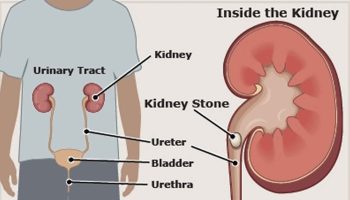 kidney stone