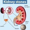 kidney stones