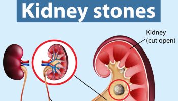 kidney stones