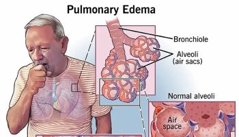 pulmonary edema