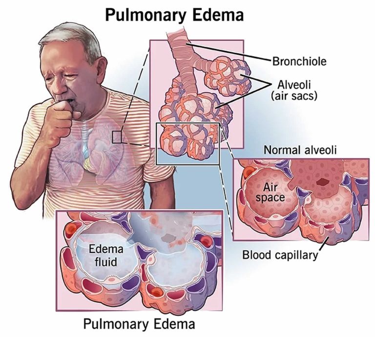 Pulmonary edema, causes, symptoms, diagnosis, treatment & prognosis