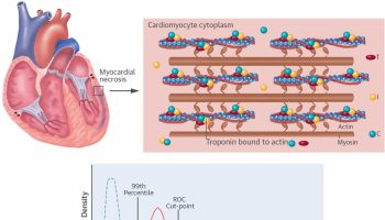 troponin