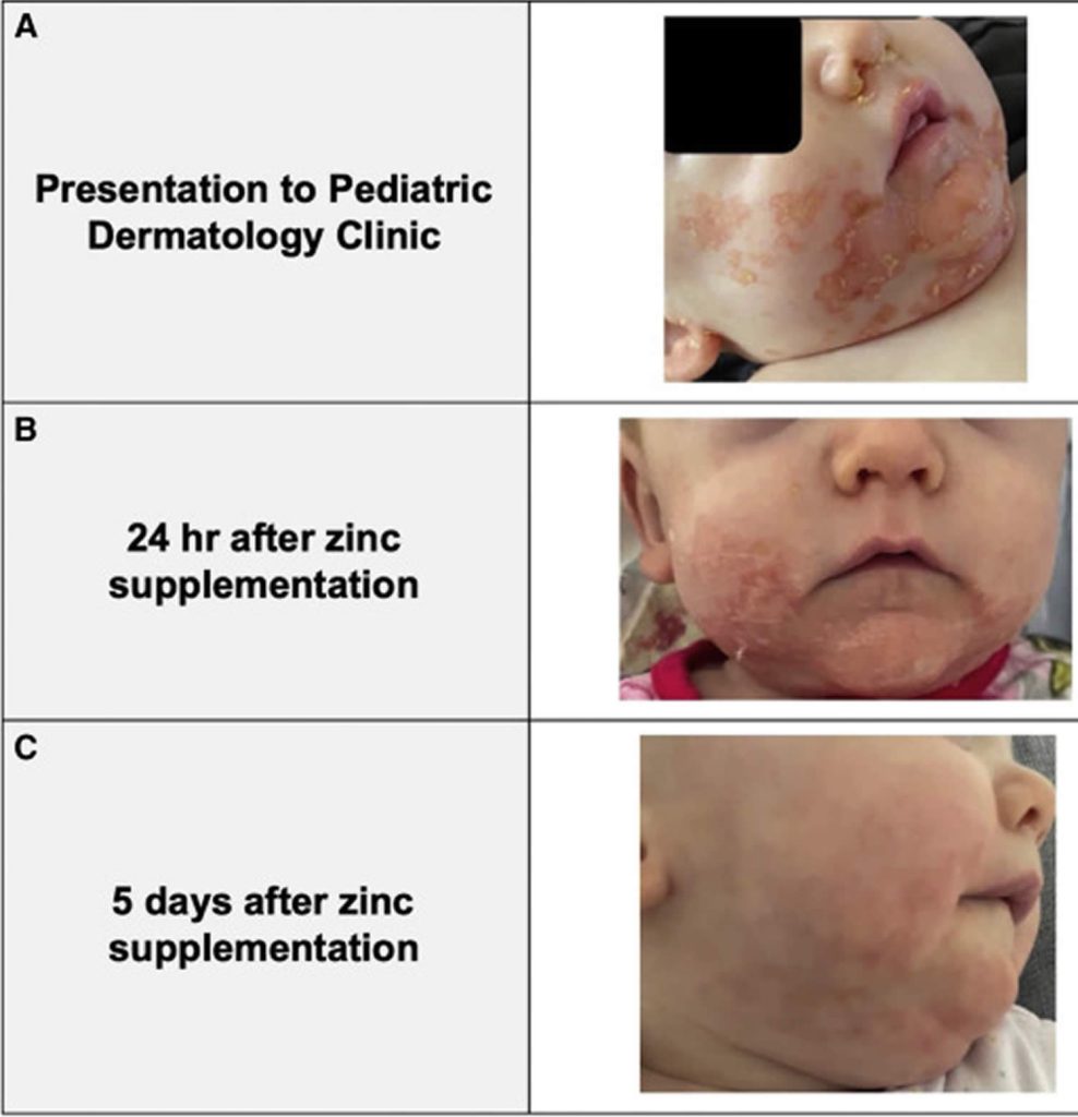 Zinc Deficiency, Causes, Signs, Symptoms, Diagnosis & Treatment