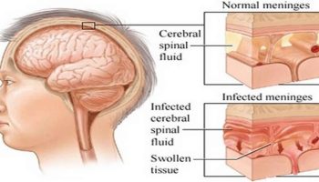 Aseptic-meningitis