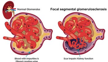 Focal segmental glomerulosclerosis