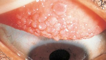 Giant papillary conjunctivitis