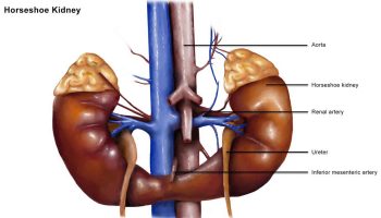 Horseshoe kidney