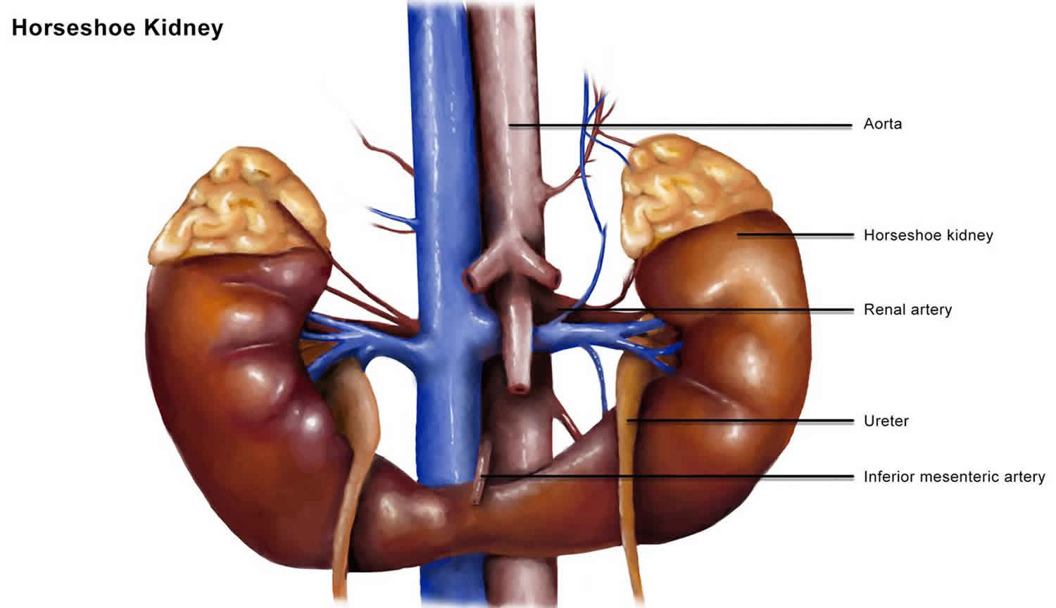 Horseshoe Kidney Causes Symptoms Complications Diagnosis Treatment