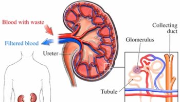 IgA nephropathy