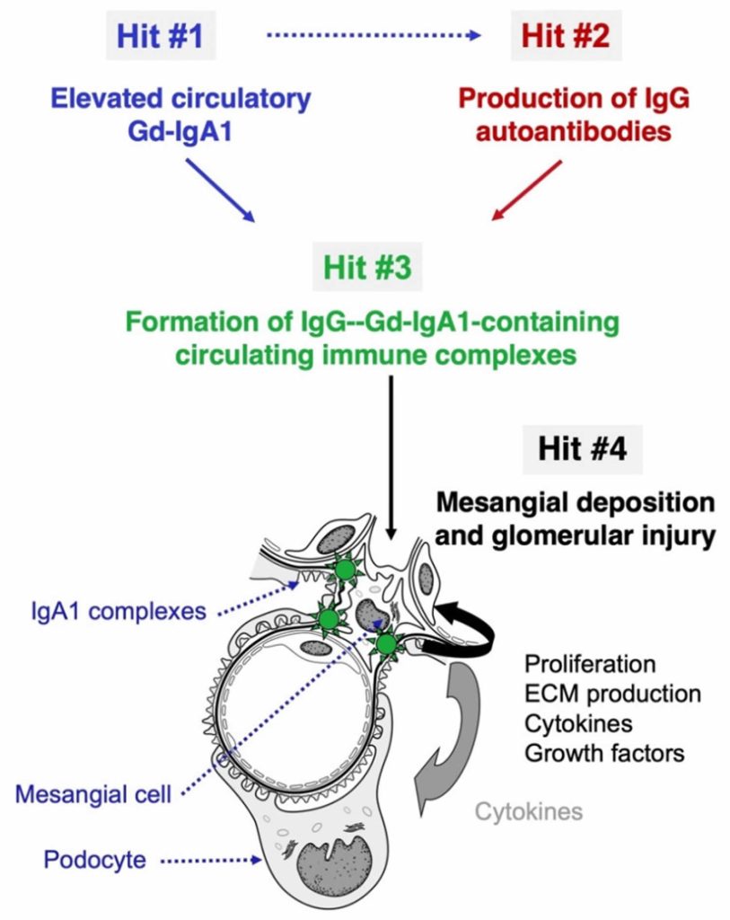 Iga Nephropathy Causes Symptoms Diagnosis Treatment And Prognosis