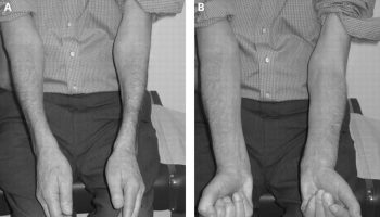 Inclusion-body-myositis