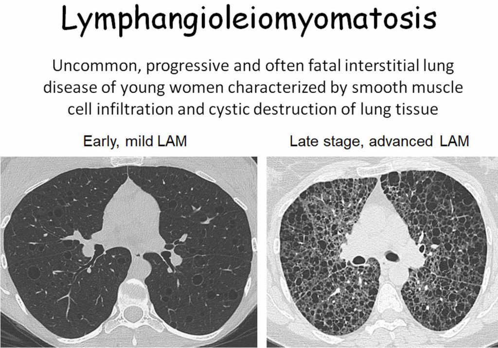 Lymphangioleiomyomatosis Causes, Symptoms, Diagnosis, Treatment & Prognosis