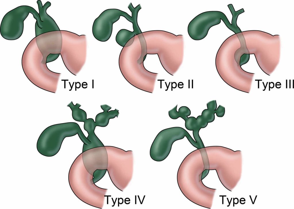 Mirizzi syndrome causes, types, symptoms, diagnosis, treatment & prognosis