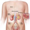 Pyelonephritis